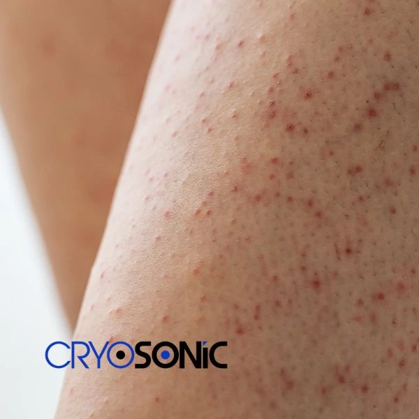 Looking for Seborrhoeic Keratosis removal Chippenham treatment? Call our consultants today in Chippenham
