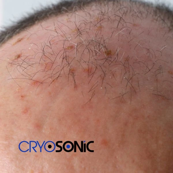 Access Seborrhoeic Keratosis removal from the comfort of your own home! Call us today in Chippenham