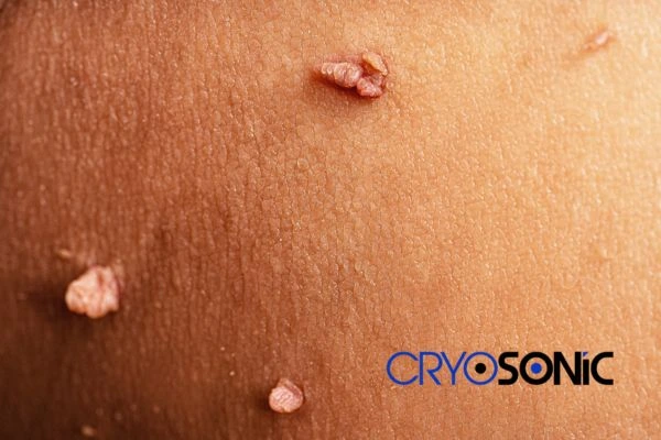 What Can You Expect During and After Your Cryosonic Treatment Chippenham